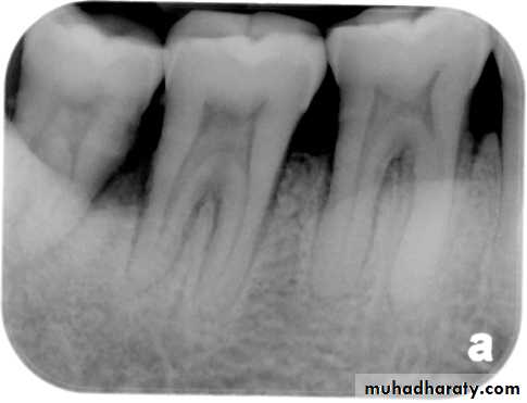 Pulpal diseases and related periapical pathosis part 22