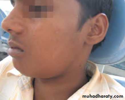 Pulpal diseases and related periapical pathosis part 22