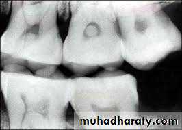 Pulpal diseases and related periapical pathosis part 22