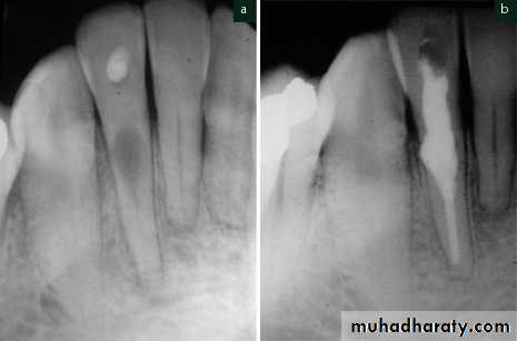 Pulpal diseases and related periapical pathosis part 22