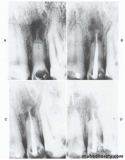 Pulpal diseases and related periapical pathosis part 22