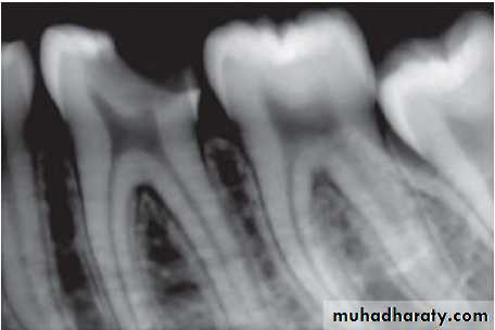 Pulpal diseases and related periapical pathosis part 22