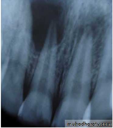 Pulpal diseases and related periapical pathosis part 22