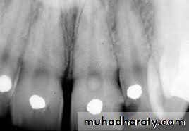 Pulpal diseases and related periapical pathosis part 22