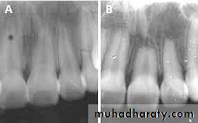 Pulpal diseases and related periapical pathosis part 22