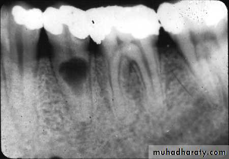 Pulpal diseases and related periapical pathosis part 22