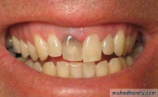 Pulpal diseases and related periapical pathosis part 22