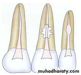 Pulpal diseases and related periapical pathosis part 22