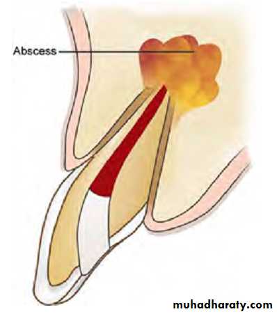 Pulpal diseases and related periapical pathosis part 22