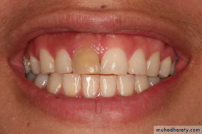 Pulpal diseases and related periapical pathosis part 22
