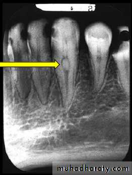 Pulpal diseases and related periapical pathosis part 22