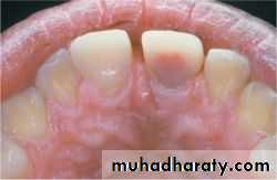 Pulpal diseases and related periapical pathosis part 22