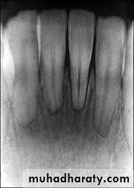 Pulpal diseases and related periapical pathosis part 22