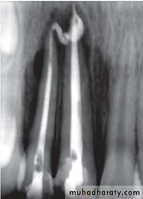 Pulpal diseases and related periapical pathosis part 22