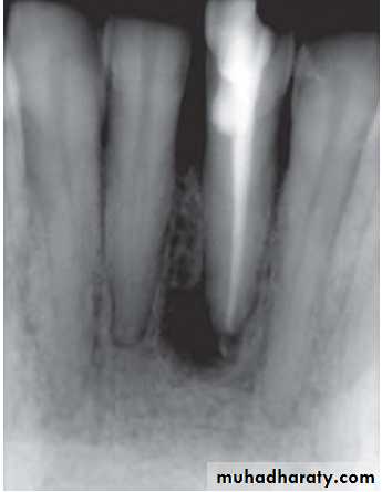 Pulpal diseases and related periapical pathosis part 22