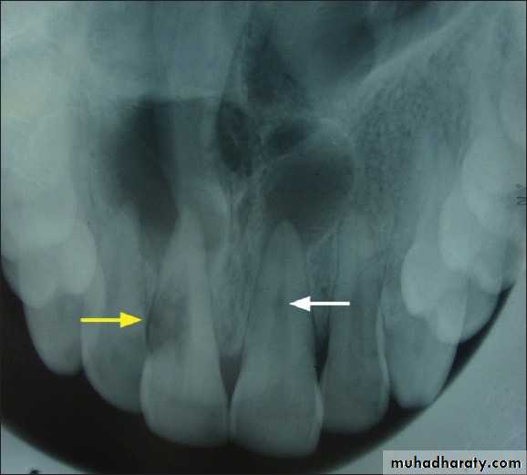 Pulpal diseases and related periapical pathosis part 22