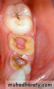 Pulpal diseases and related periapical pathosis part 22