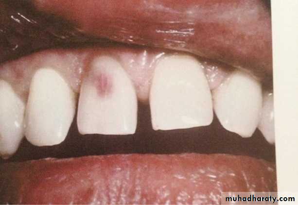 Pulpal diseases and related periapical pathosis part 22