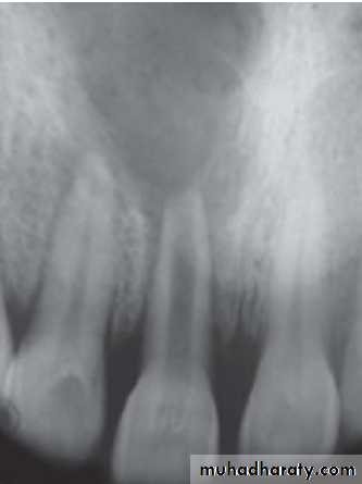Pulpal diseases and related periapical pathosis part 22