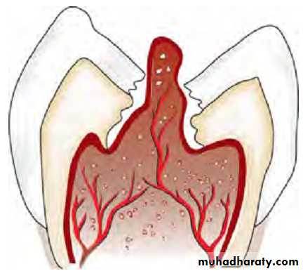 Pulpal diseases and related periapical pathosis part 22