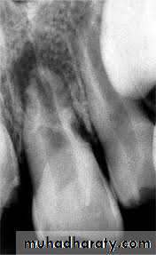 Pulpal diseases and related periapical pathosis part 22