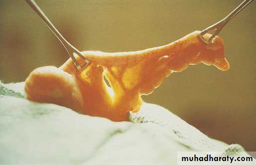 The Vermiform Appendix