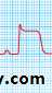 STEMI