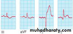 STEMI