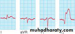 STEMI