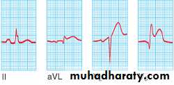 STEMI