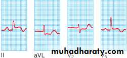 STEMI