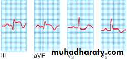 STEMI