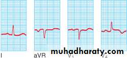 STEMI