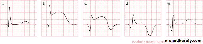 STEMI