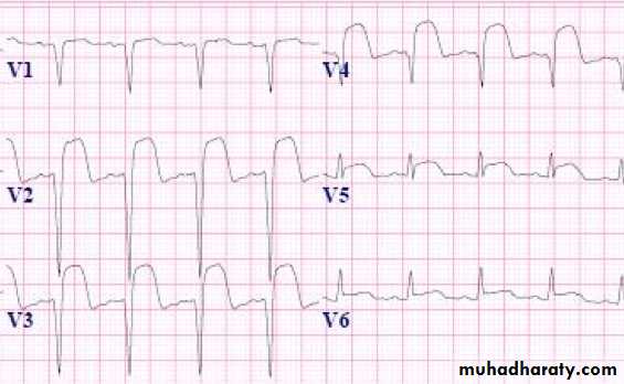 STEMI