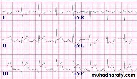 STEMI