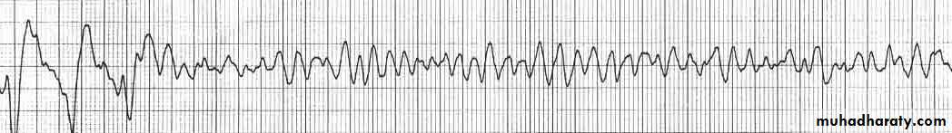 STEMI