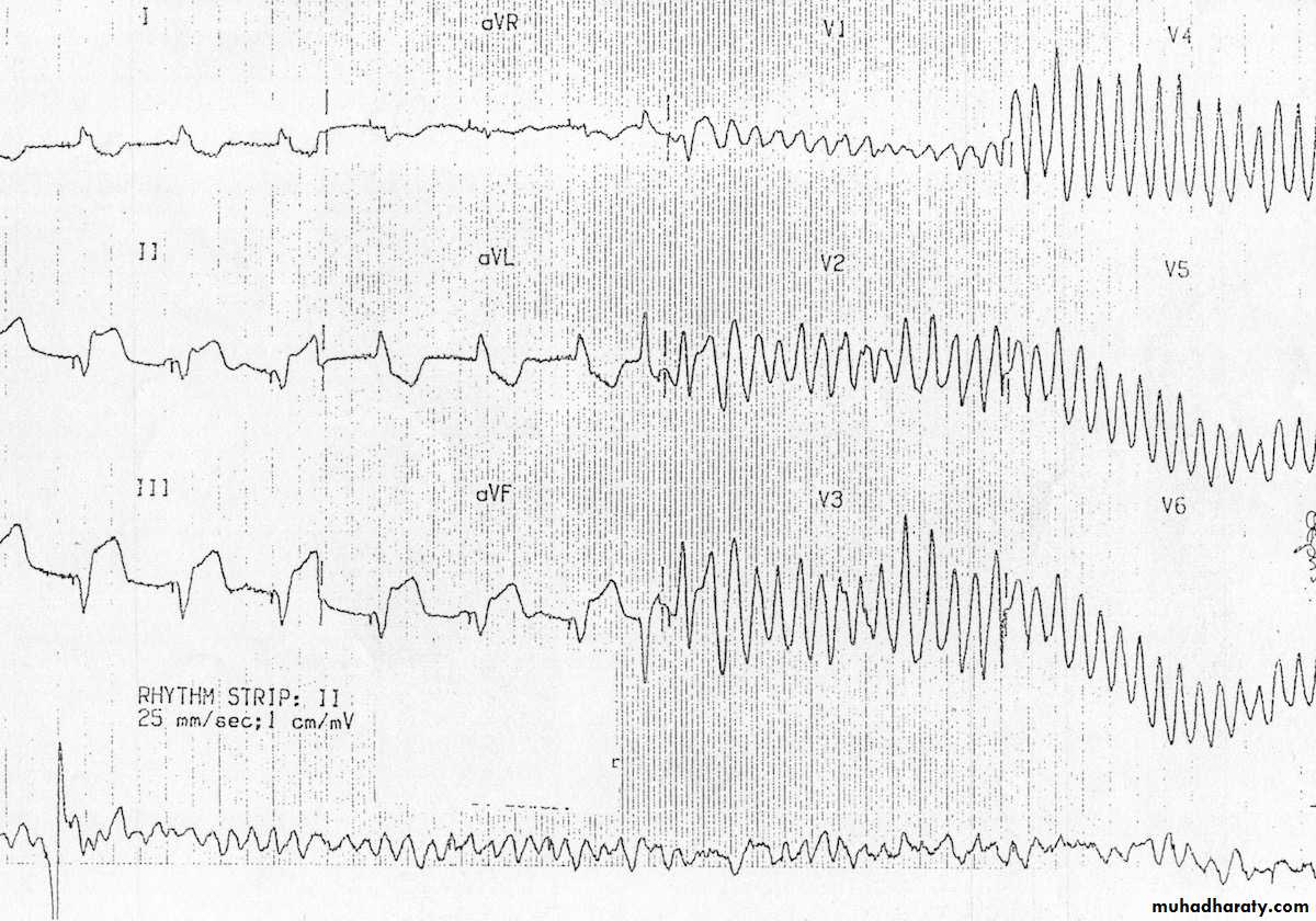 STEMI