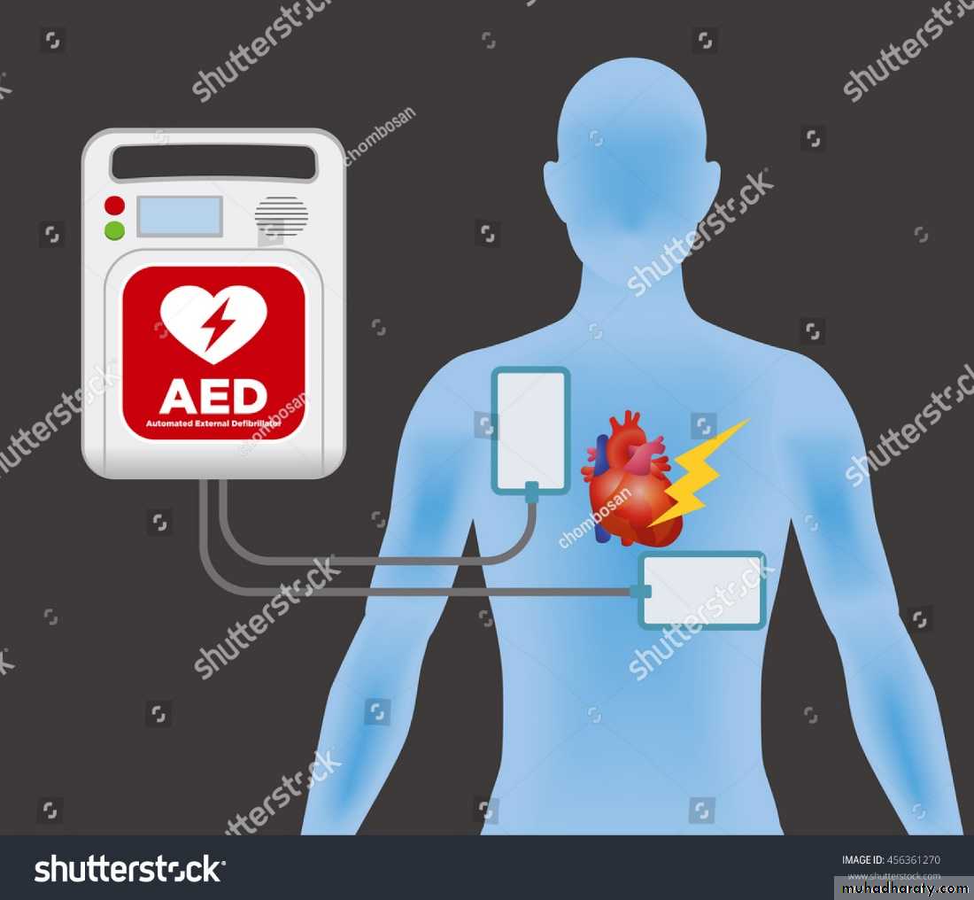 STEMI