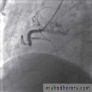STEMI