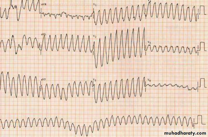 STEMI