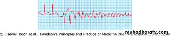 STEMI