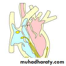 STEMI