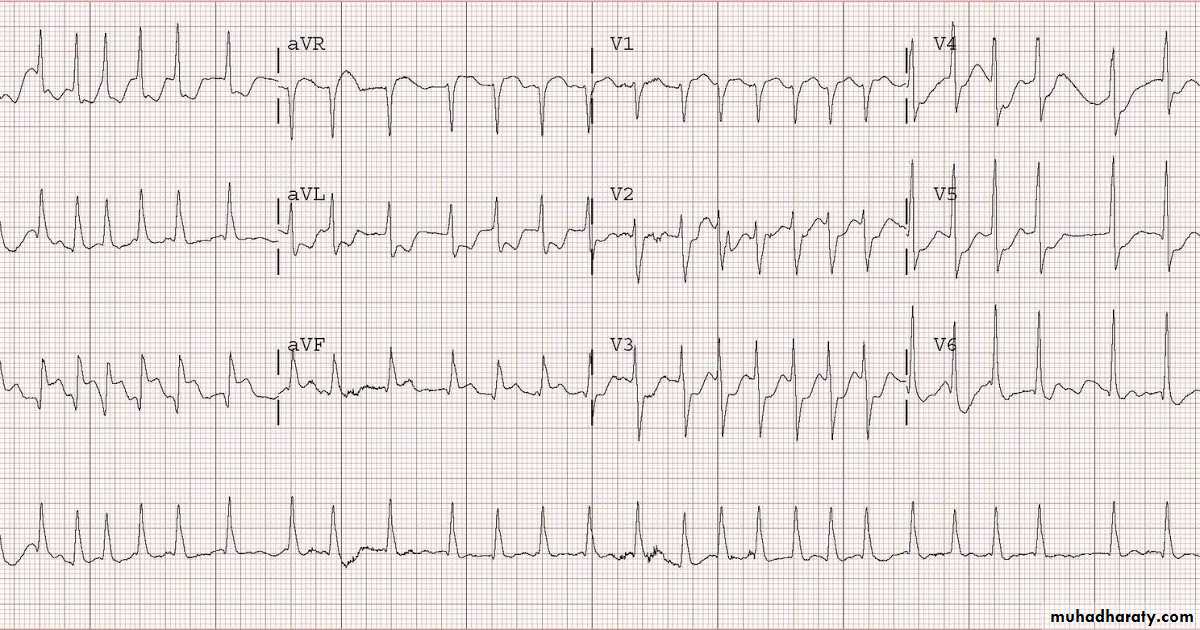STEMI