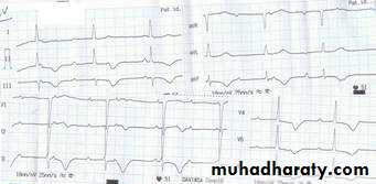 STEMI