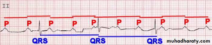 STEMI
