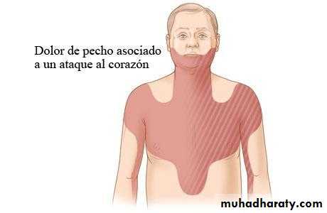 STEMI