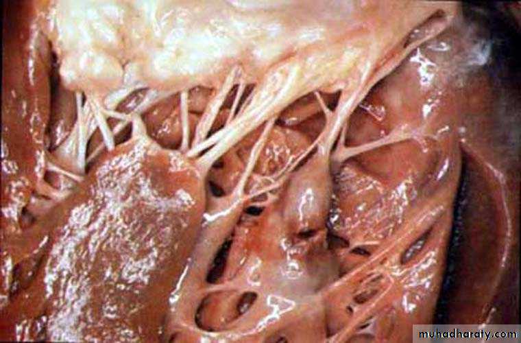 STEMI