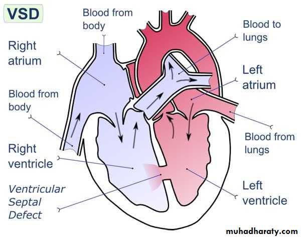STEMI