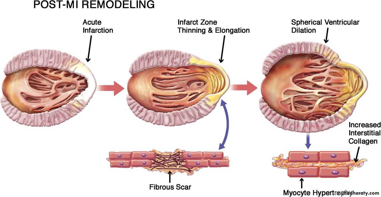 STEMI